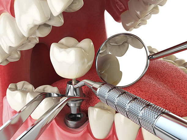 Best Broken or Cracked Tooth Emergency Dentist in Des Moines, IA